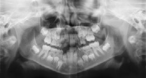 Dental Radiographs (X-Rays) - Pediatric Dentist in Livingston, NJ