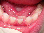 Baby Teeth - Pediatric Dentist in Livingston, NJ
