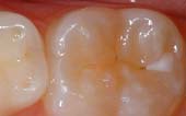 Sealant-Before - Pediatric Dentist in Livingston, NJ